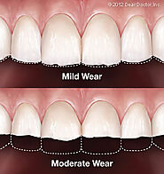 Tooth Wear, Its Types and Treatment