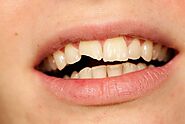 What To Do If Your Tooth Loses A Crown or Cracks? | Detailed Guide