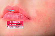 5 Popular Perioral Dermatitis Natural Treatment To Consider | How To Cure