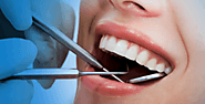Invisalign: the Best Treatment for Unaligned Teeth