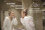 Scar Free Mole Removal Treatment - Clinic 2000