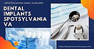 Need Of Dental Implants Fredericksburg VA - Spotsylvania Oral Surgery