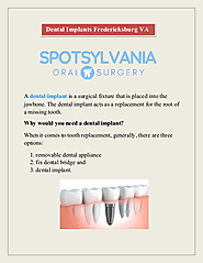 Dental Implants Fredericksburg VA | edocr
