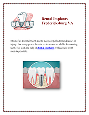 Dental Impants Fredericksburg VA | edocr