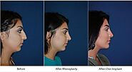Rhinoplasty surgery in Charlotte, NC and how to find the best nose job surgeon