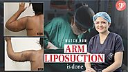 Watch how ARM LIPOSUCTION is done (Full Procedure)