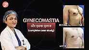 Gynecomastia Surgery Case Study | Gynecomastia सर्जरी का सम्पूर्ण अध्ययन