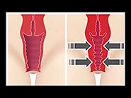 Laser Vaginal Tightening Treatment - Box Hill Superclinic
