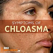 Chloasma: Characteristics, Causes & Treatment | BulkSupplements.com