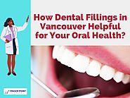 How Dental Fillings in Vancouver Helpful for Your Oral Health?
