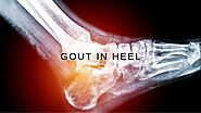 Gout in Heel