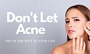Share4all » Health » Do Not Allow Acne Breakouts Get In the Manner of the Own Life