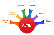 Why Holistic Treatment is the Best Approach To Cure Chronic Acne