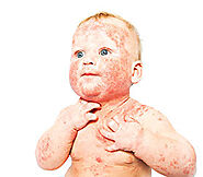 Why You Should Consider the Natural Treatments for curing Your Eczema?