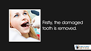• Firstly, the damaged tooth is removed.