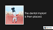 • The dental implant is then placed