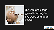 • The implant is then given time to grow the bone and to let it heal