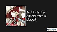 • And finally, the artificial tooth is placed.