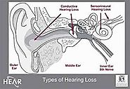 7 Basic Facts of Hearing Loss | Tinnitec Review