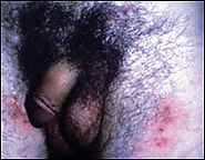 Genital Herpes: A Review - American Family Physician