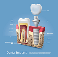 Can you get dental implants when you lose teeth due to gum disease? – Dental Care Services