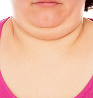 Double Chin Treatment in Bangalore