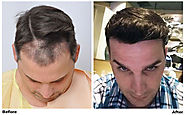 Hair Restoration Reviews - Real or Fake?