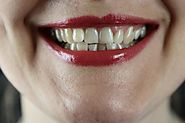 What is Wisdom Teeth Recovery Like?