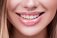 Different Types of Teeth Whitening Options