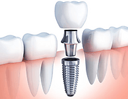 Dental Implants | Admire Dentistry