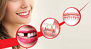 Replacement of Missing Teeth service | Admire Dentistry