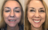 View Our Before & After Dental Treatments Gallery | Sleep Dream Smile