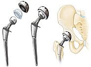 Hip Replacement Surgeon in Indore