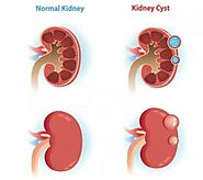 What Should PKD Patient Pay Attention to-Hebei Kidney Disease Hospital of Traditional Chinese Medicine