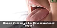 Thyroid Disease: Do You Have a Scalloped Tongue?