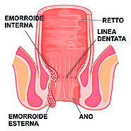 Emorroidi: sintomi cause e prevenzione - ISSalute