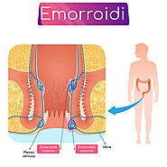 Emorroidi esterne ed interne: rimedi, cura, sintomi, ... - Farmaco e Cura