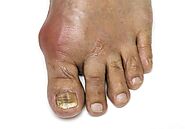 Chennai's best Siddha Clinic for Gout | Herbal Health Care