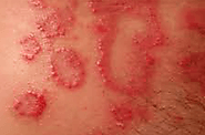 Siddha treatment for Psoriasis Chennai | Herbal Health Care