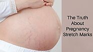 The Truth About Pregnancy Stretch Marks
