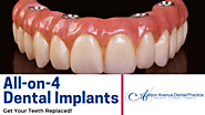 How to Clean All on 4 Dental Implants? | Quora