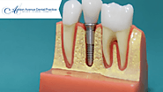 How Can Dental Implants be Helpful for You?