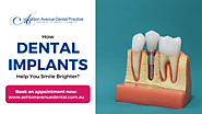 Dental Implants: For Brighter and Confident Smile