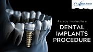 How Long does it take for Dental Implants?