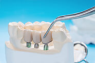 7 Unique Features of All-On-4 Dental Implants - EasytoEnd