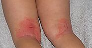 What is Eczema and How it is Treated Naturally?