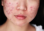 Best Dermatologist For Cystic Acne Treatment In Mumbai