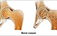 Consult Cancer Specialist for Bone Cancer Treatment In India