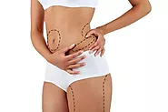 Liposuction in Lucknow - Dr.Sumit Malhotra
