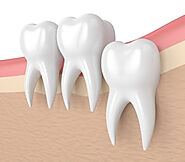 Perform Wisdom Teeth Removal To Relieve The Pain
